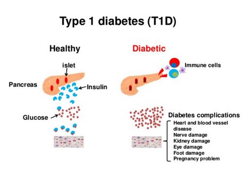 Type 1 Diabetes Vs Type 2 Diabetes Comparison Chart