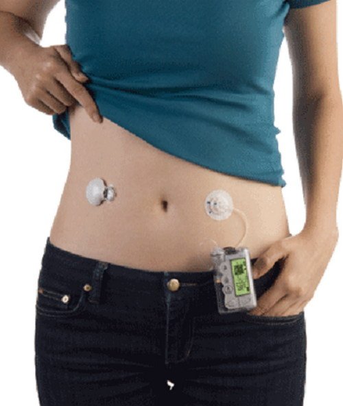 A continuous glucose monitor can be attached on different parts of the body such as the abdomen image photo picture