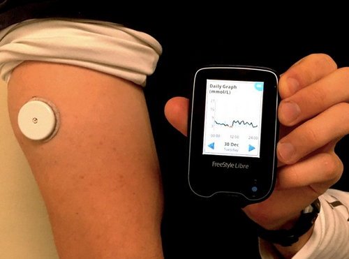 A continuous glucose monitor device attached on the arm image photo picture